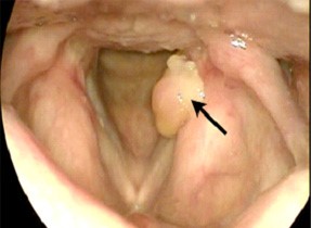 Granuloma vocal - Exemplo