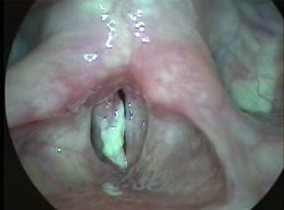 papillomavirus nas cordas vocais