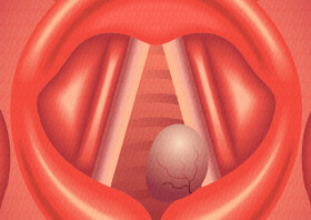 Granuloma vocal